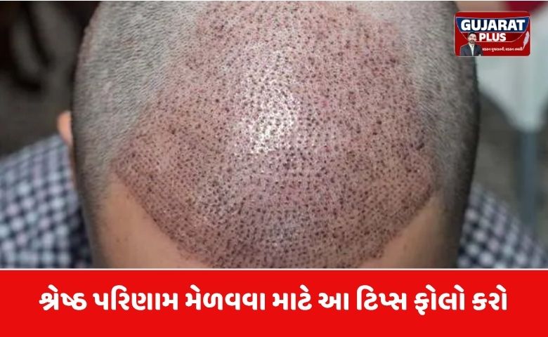 હેર ટ્રાન્સપ્લાન્ટ પછી આટલું ધ્યાન રાખશો તો જ મળશે બેસ્ટ રિઝલ્ટ