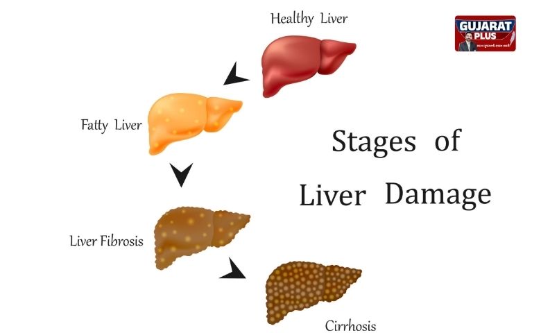 Fatty Liver Disease: દારૂ વગર પણ લીવર થઈ શકે છે ડેમેજ, જાણો બચવાના ઉપાય