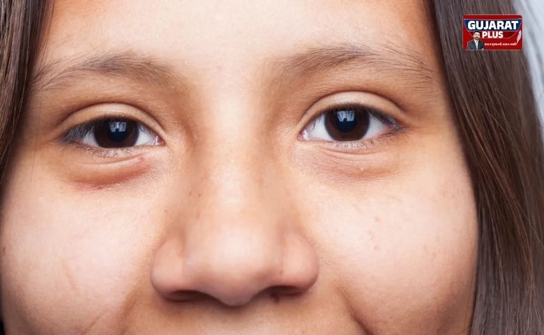 આંખો નીચેના સોજા (Puffiness) થી છો પરેશાન? ડૉક્ટરે જણાવ્યા દૂર કરવાના સરળ ઉપાયો